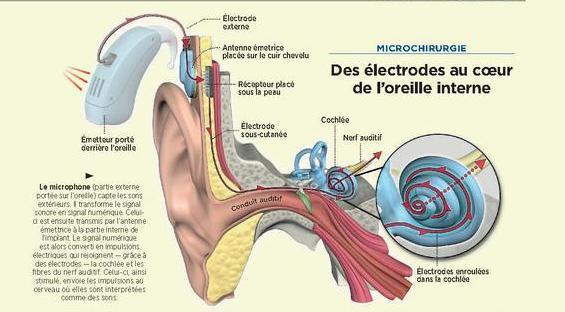 Un implant destiné aux enfants nés sans nerf auditif - Sciences et Avenir